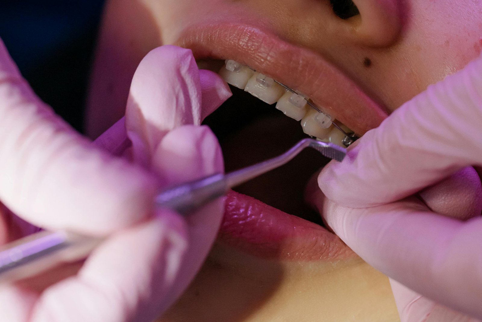 Imagen-brackets